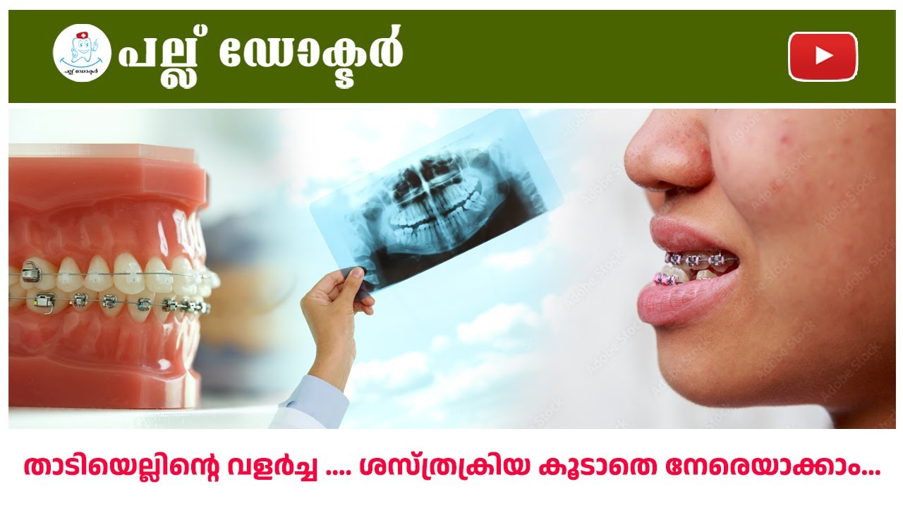താടിയെല്ലിന്റെ വളർച്ച .... ശസ്ത്രക്രിയ കൂടാതെ നേരെയാക്കാം...