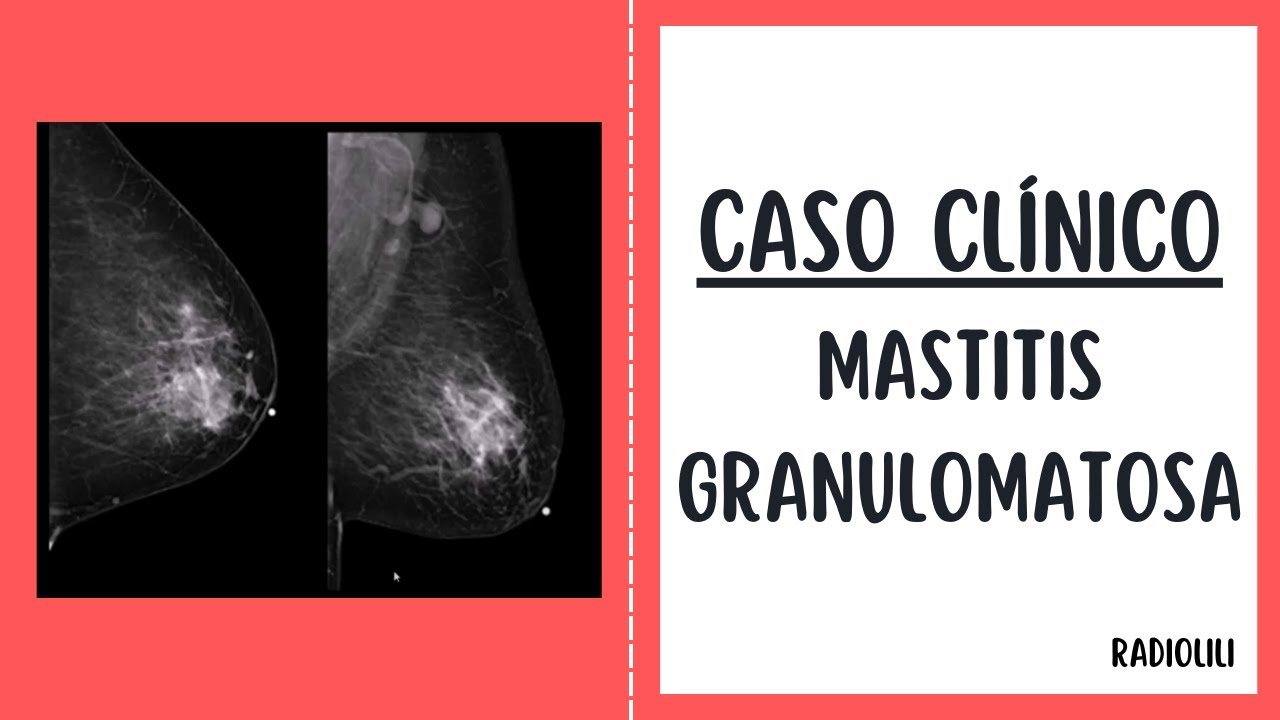 Mastitis granulomatosa: Caso Clínico.