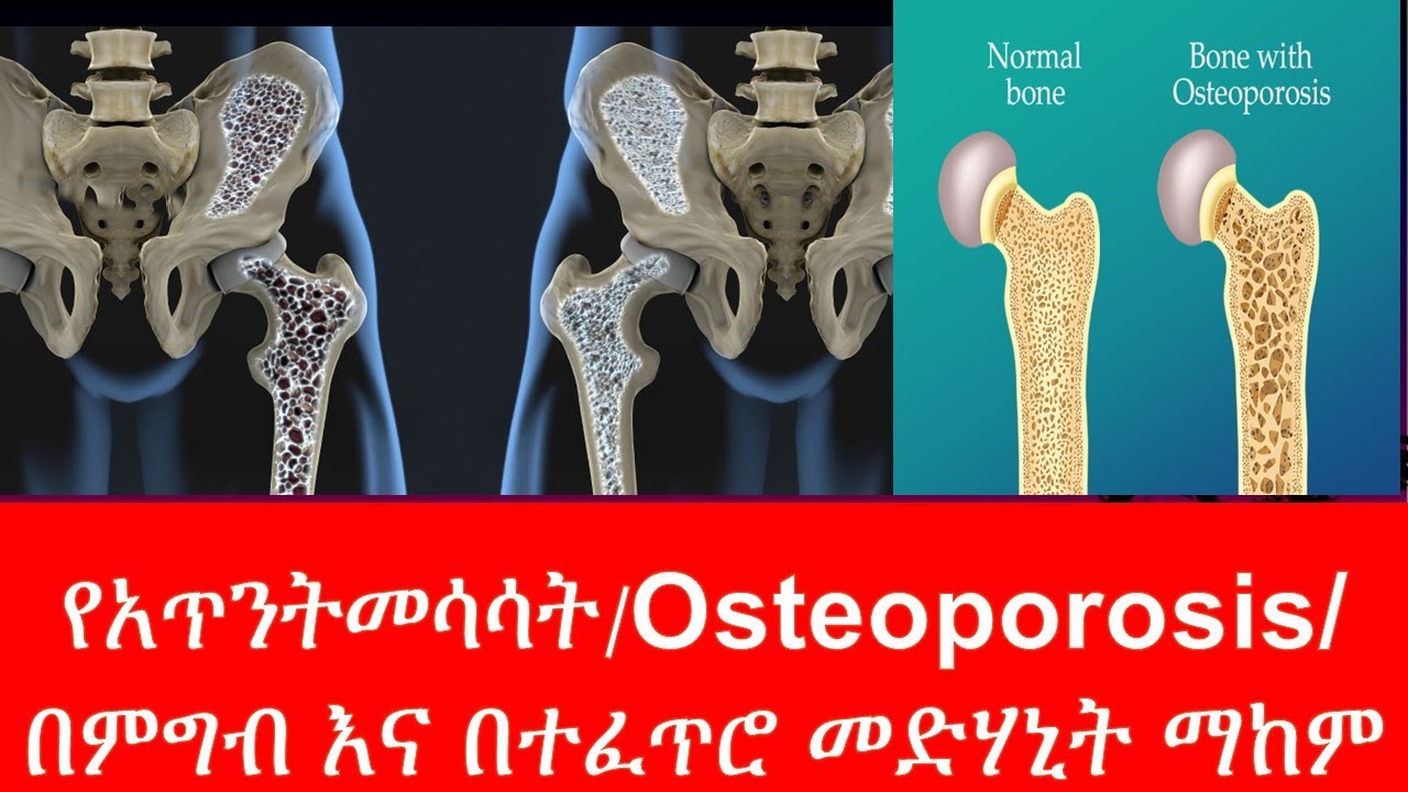 የአጥንት መሳሳት/Osteoporosis/ በምግብ እና በተፈጥሮ መድሃኒት ማከም