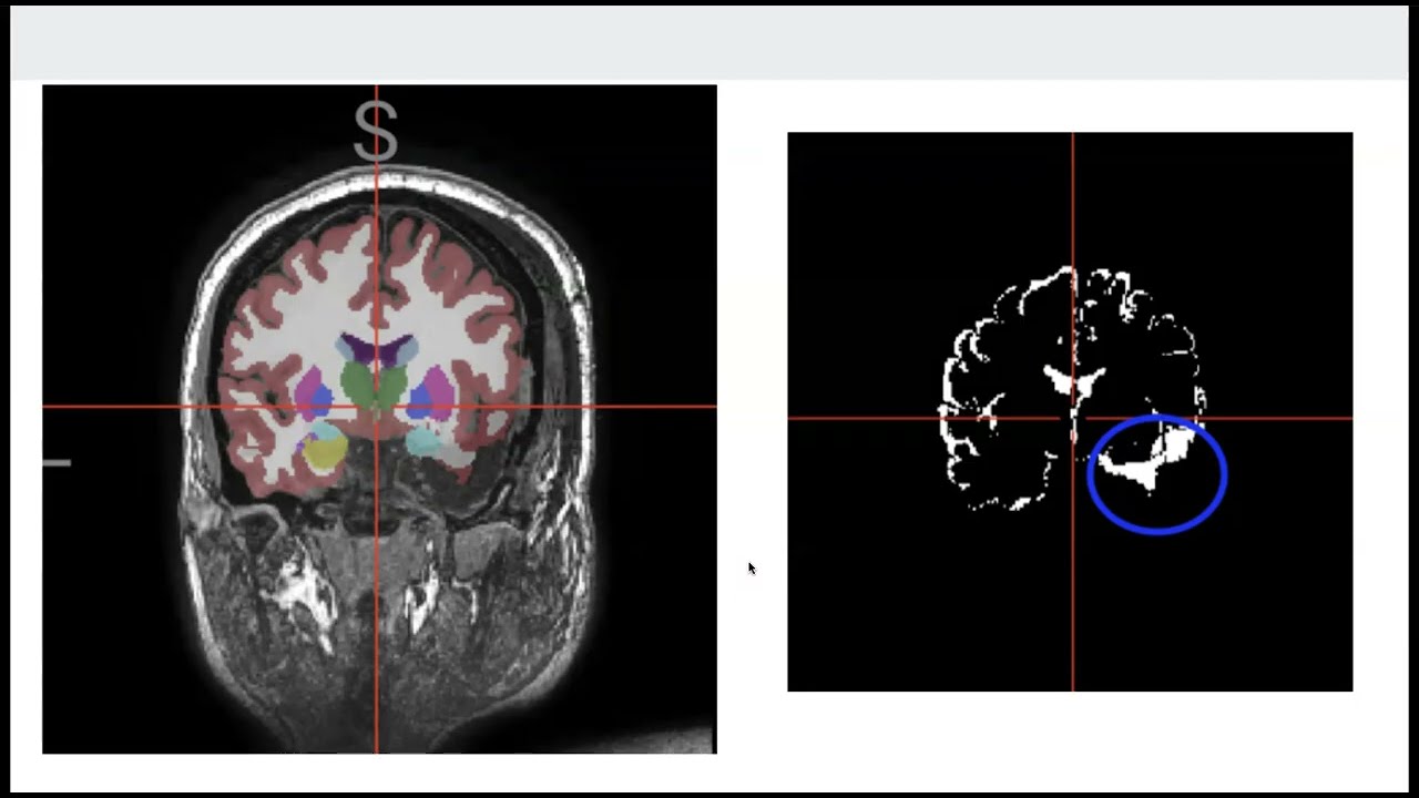 MS project defense: Synthetic Epilepsy Post-op Lesion Generation by Alenka Tang