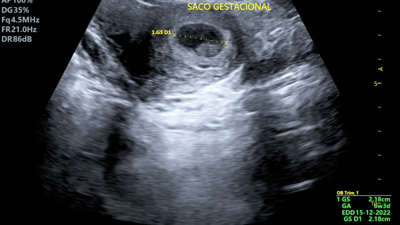 6 SEMANAS DE GESTACIÓN Y NO SE PERCIBE FRECUENCIA CARDÍACA FETAL QUE HACER?