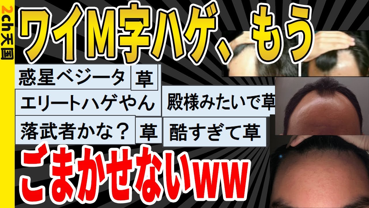 【2ch面白いスレ】ワイM字ハゲ、とうとうごまかしが効かなくなるｗｗｗｗｗ　聞き流し/2ch天国
