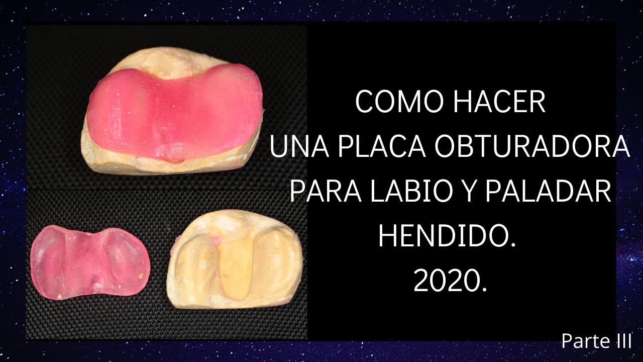 Como hacer una placa obturadora para labio y paladar hendido 2020.