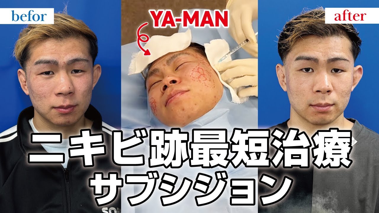 【ニキビ跡治療】サブシジョンをやったら効果ありすぎた