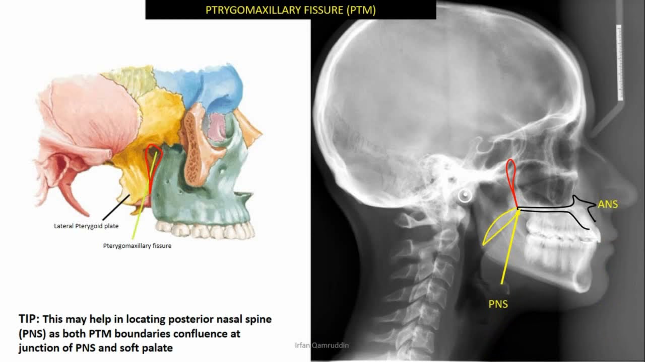 Identifiable anatomical structures in lateral cephalometric radiograph (ceph tracing 1)