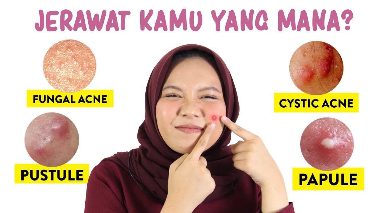 Jenis Jerawat dan Cara Mengatasinya | Skincare101