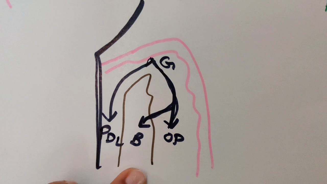 Bone loss and bone destruction patterns in periodontal disease part-1