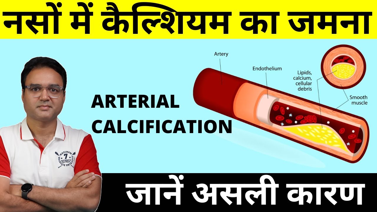 #1 Reason Why Calcium Deposits In Your Arteries & Blocks Them (Coronary Artery Calcification)