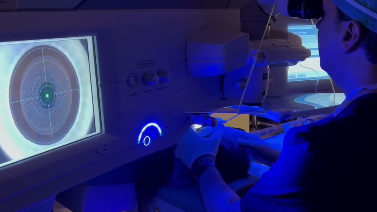 Creation of the Lenticule during ZEISS SMILE