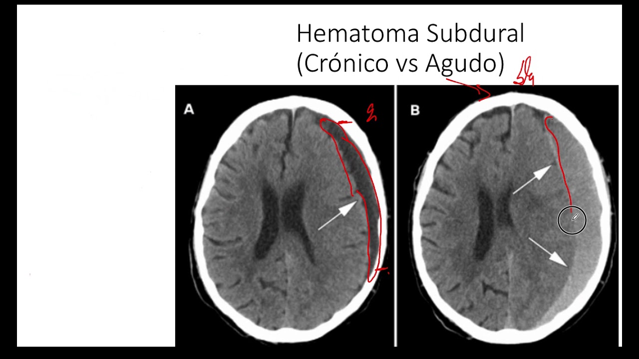 Hematoma Subdural . Tomografía Computarizada. Hemorragia Intracraneal