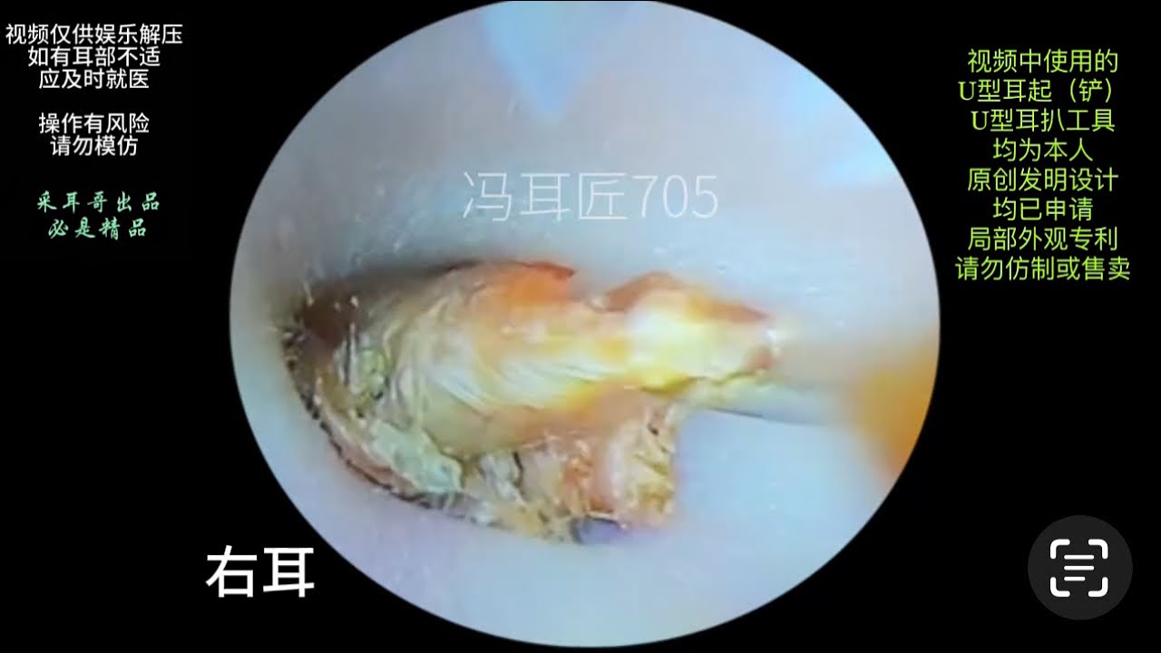 采耳哥-Children's blocked ears cleaned｜705