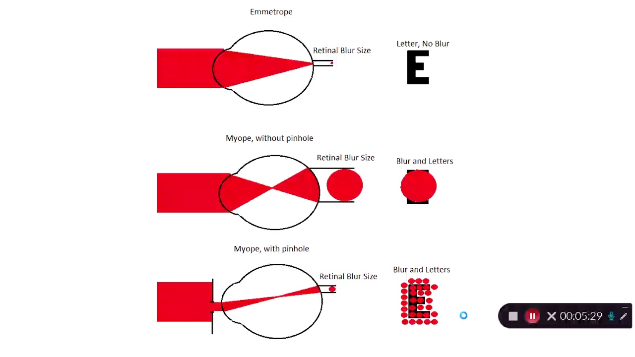 Visual Acuity in Refraction and Refractive Error