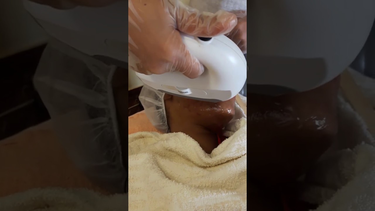 Laser Stretchmarks removal in Abuja Nigeria at Derma Contour Aesthetic & Beauty Clinic