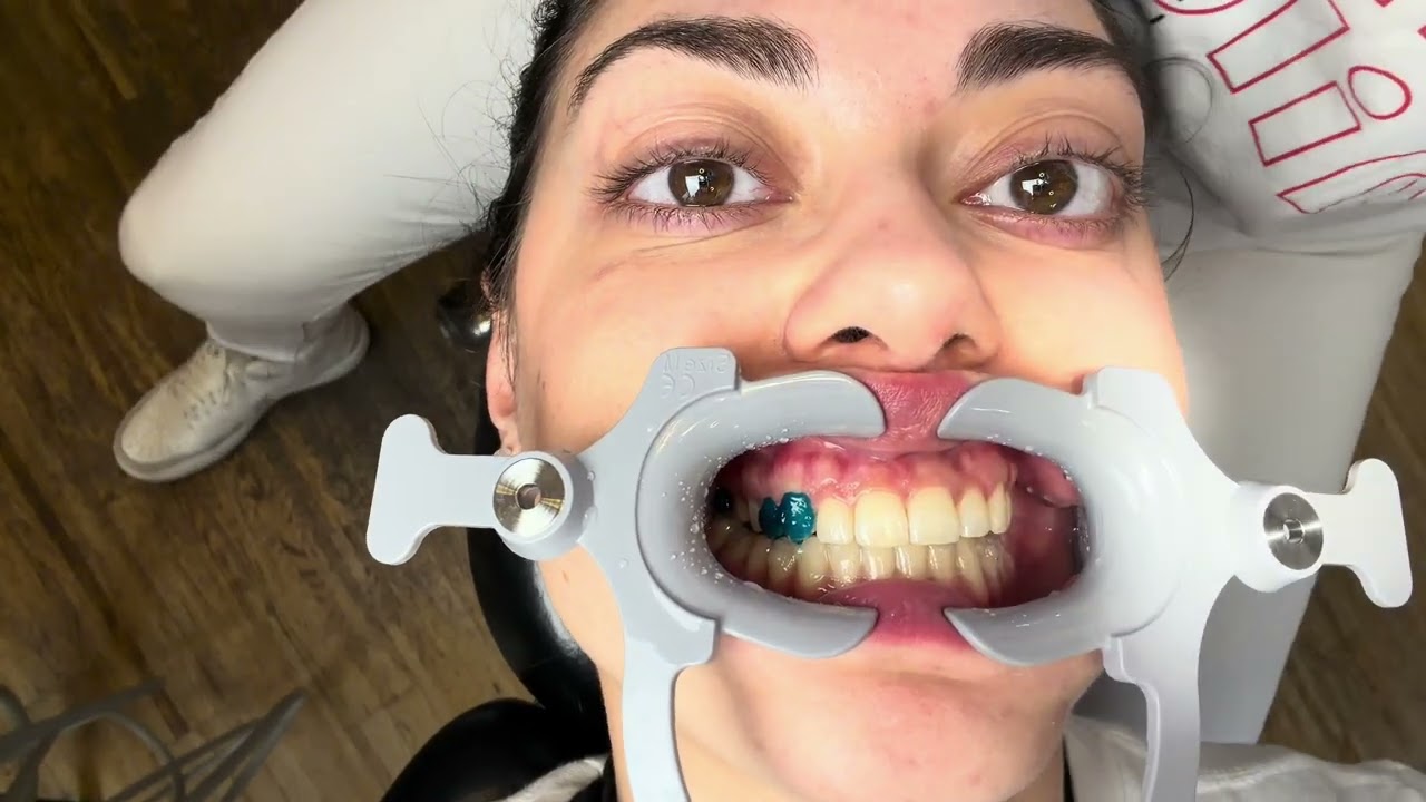 Invisalign Start: So werden Attachments geklebt 😍 Meine Aligner Reise beginnt!