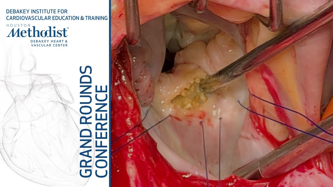 Progress in Our Understanding of Mitral Annular Calcification (Gerald Lawrie, MD) March 28, 2019
