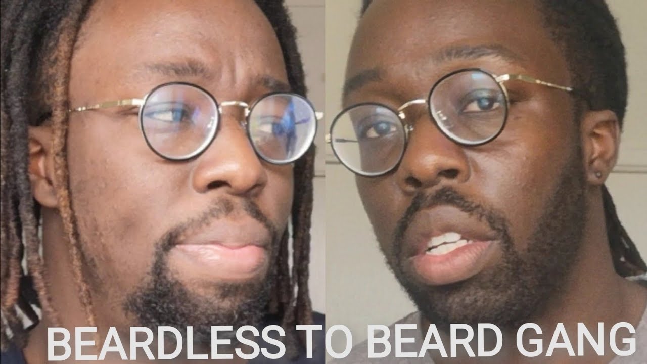 Crazy 3 month MINOXIDIL beard transformation