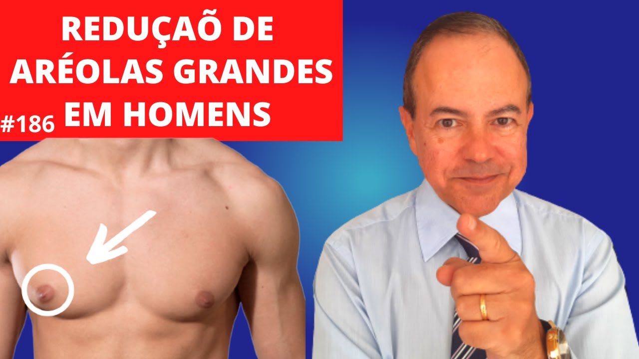 Posso diminuir só as aréolas? Não tenho GINECOMASTIA [Dr. Jacintho - Cirurgião Plástico]