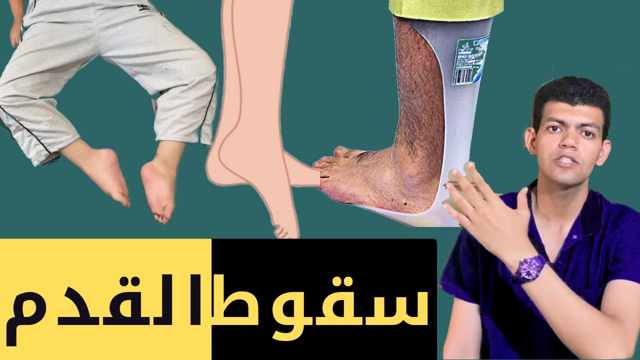 مشكلة سقوط القدم/الاسباب/العلاج/معدل الشفاء