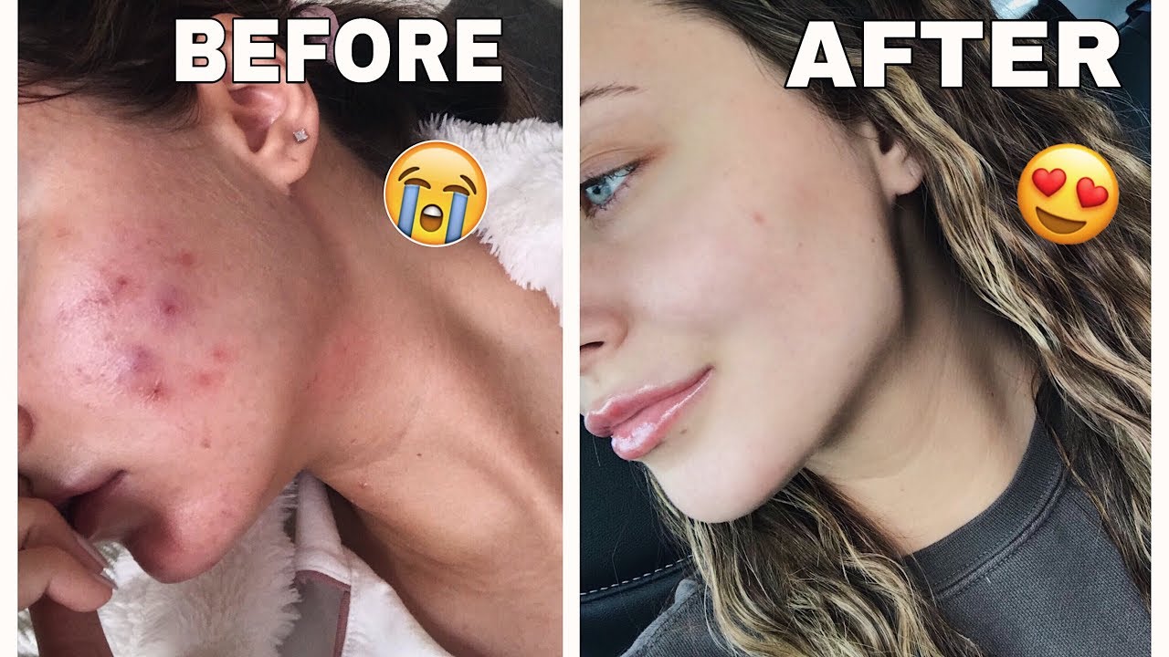 HOW I CLEARED MY SKIN IN 30 DAYS *naturally*