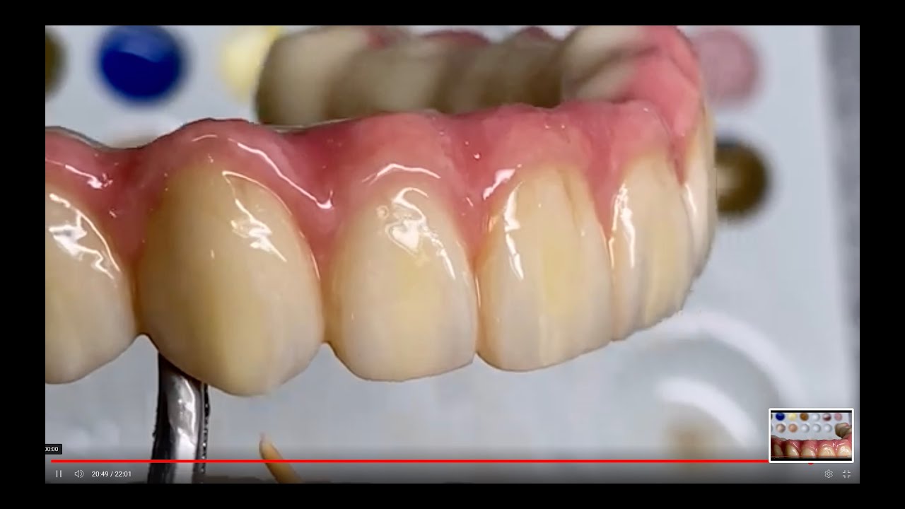 How to Make Full Contour Upper Arch With Tissue Hybrid