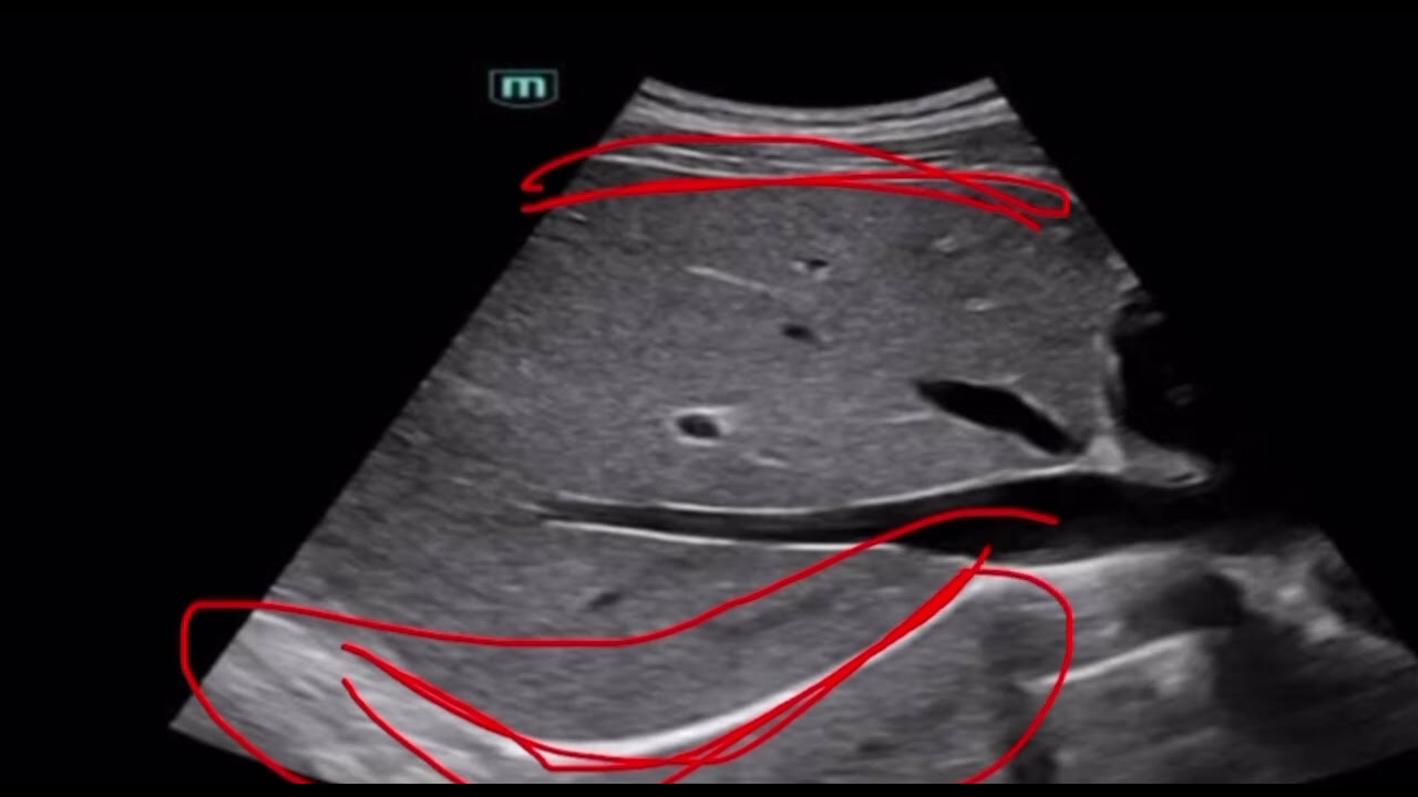 Notmal and abnormal liver in Ultrasound (محاضرة 2 عملي سونار )