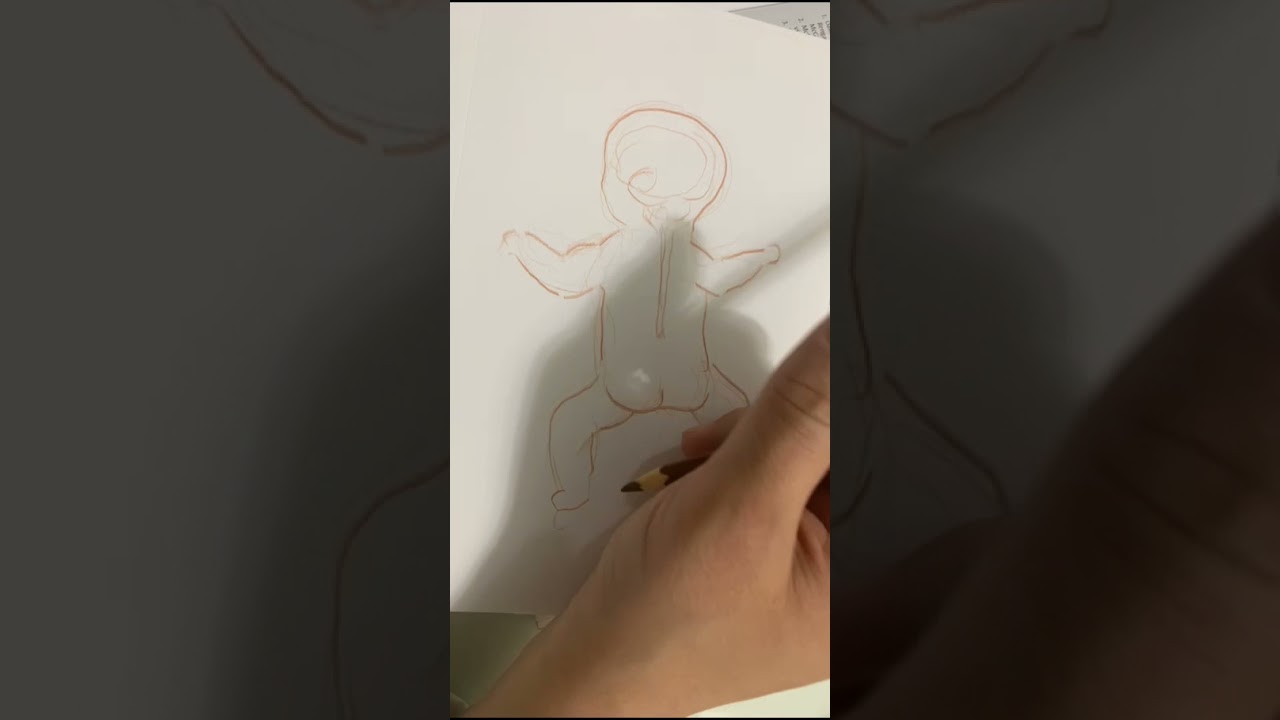 القيلة السحائية النخاعية (الصلب المشقوق), لغير المتخصصين. (Myelomeningocele, Spina Bifida Aperta)