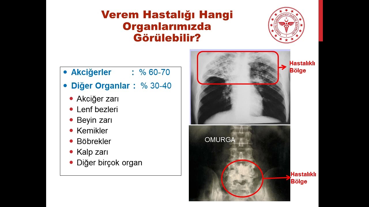 #Halk Egitim Sunusu   VEREM