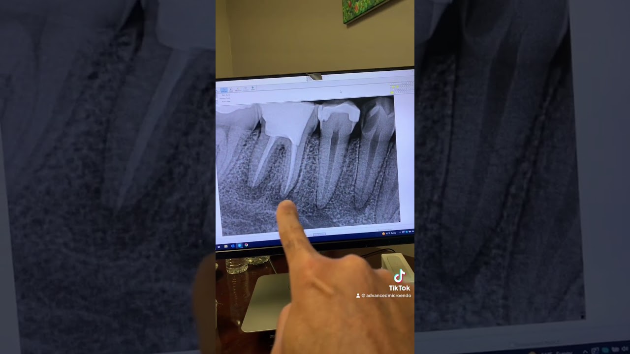 Sealer or MTA extrusions! Good? Bad? Or makes no difference?