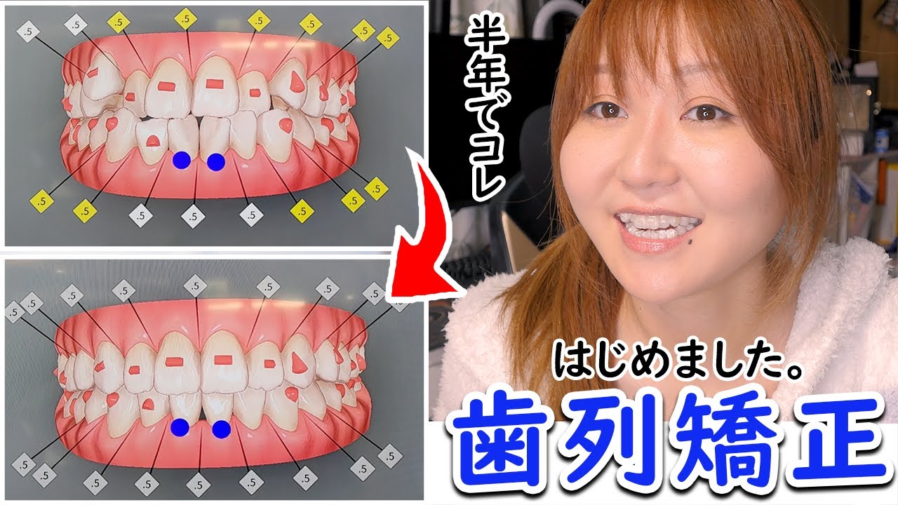 【インビザライン】総額いくら？歯並びガタガタの私がついに動く。