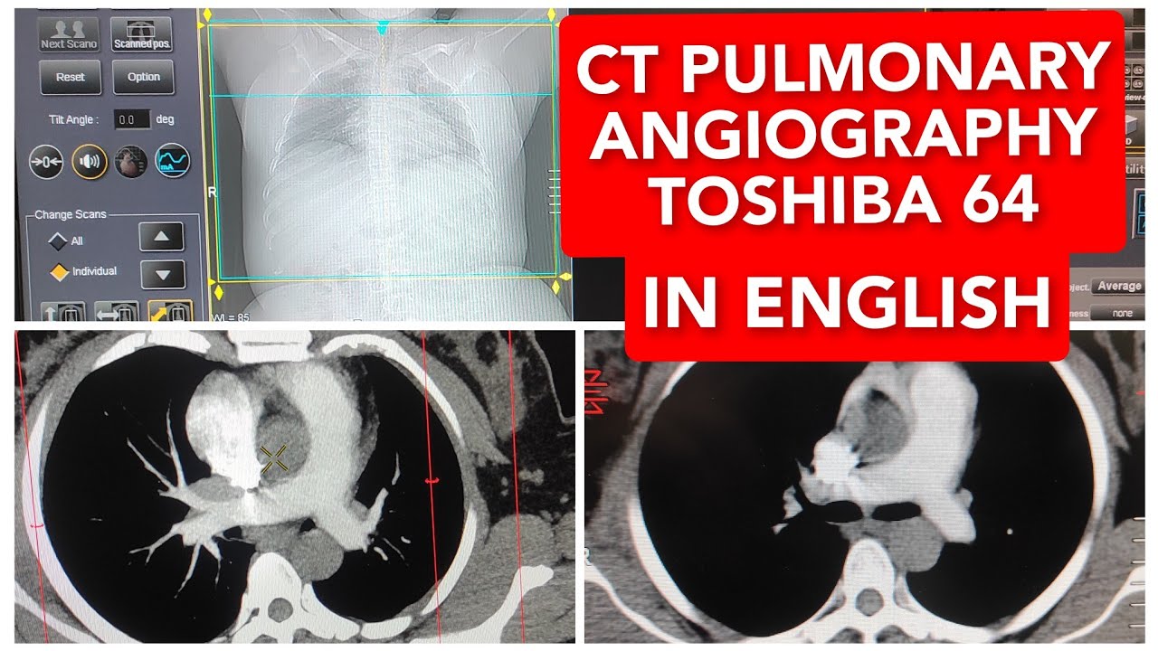 CT Pulmonary Angiography on Toshiba 64 Slice.