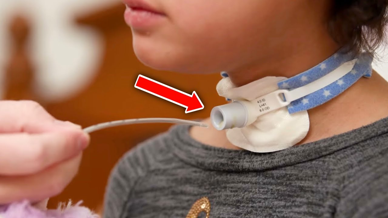 ماهي عمليةال Tracheostomy(يتنفس من الرقبة بدل الأنف) What is tracheostomy