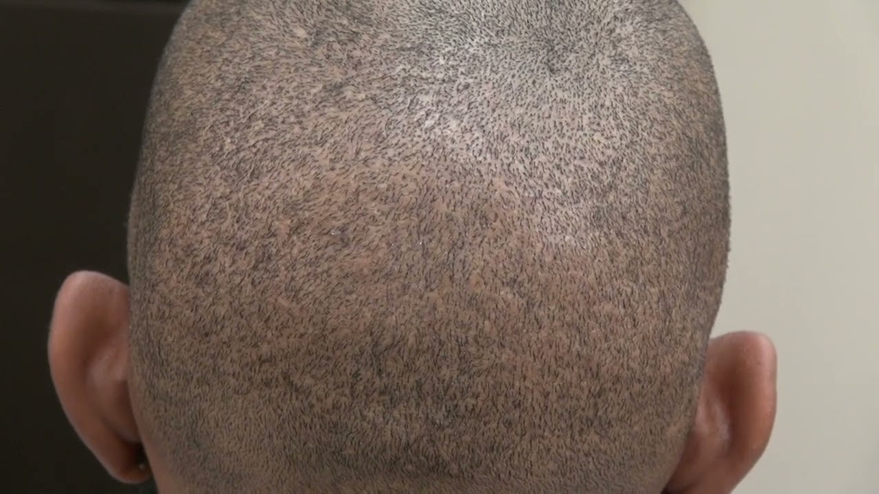 FUE scar on African American Patient by Los Gatos Hair Transplant
