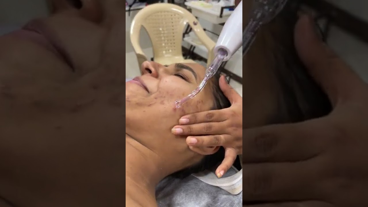 Anti-Acne Treatment | High Frequency Spot Knob | Skin Department-Trainer | Sakshi Deshpande Nachan