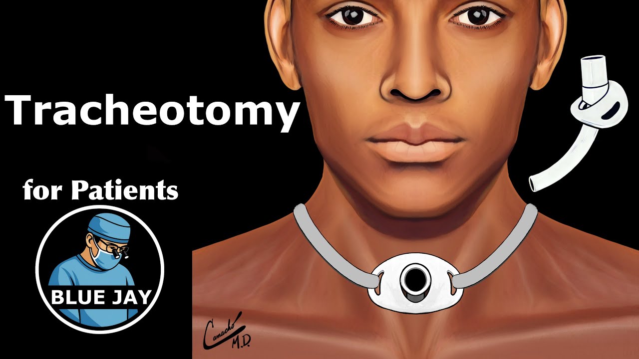 Tracheostomy: Patient Education