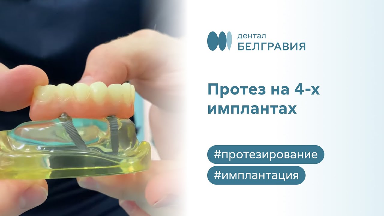 😬 Протезирование зубов по системе All-on-4
