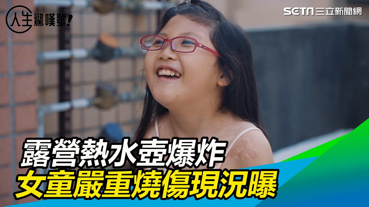 為愛重生／露營熱水壺爆炸！女童嚴重燒傷　疤痕緊纏上半身｜三立新聞網 SETN.com