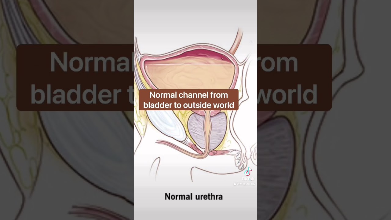Posterior Urethral Valves