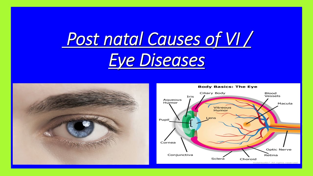 Disease of Eyes #post natal Causes of VI #Visual Impairment #Disease #Eyes