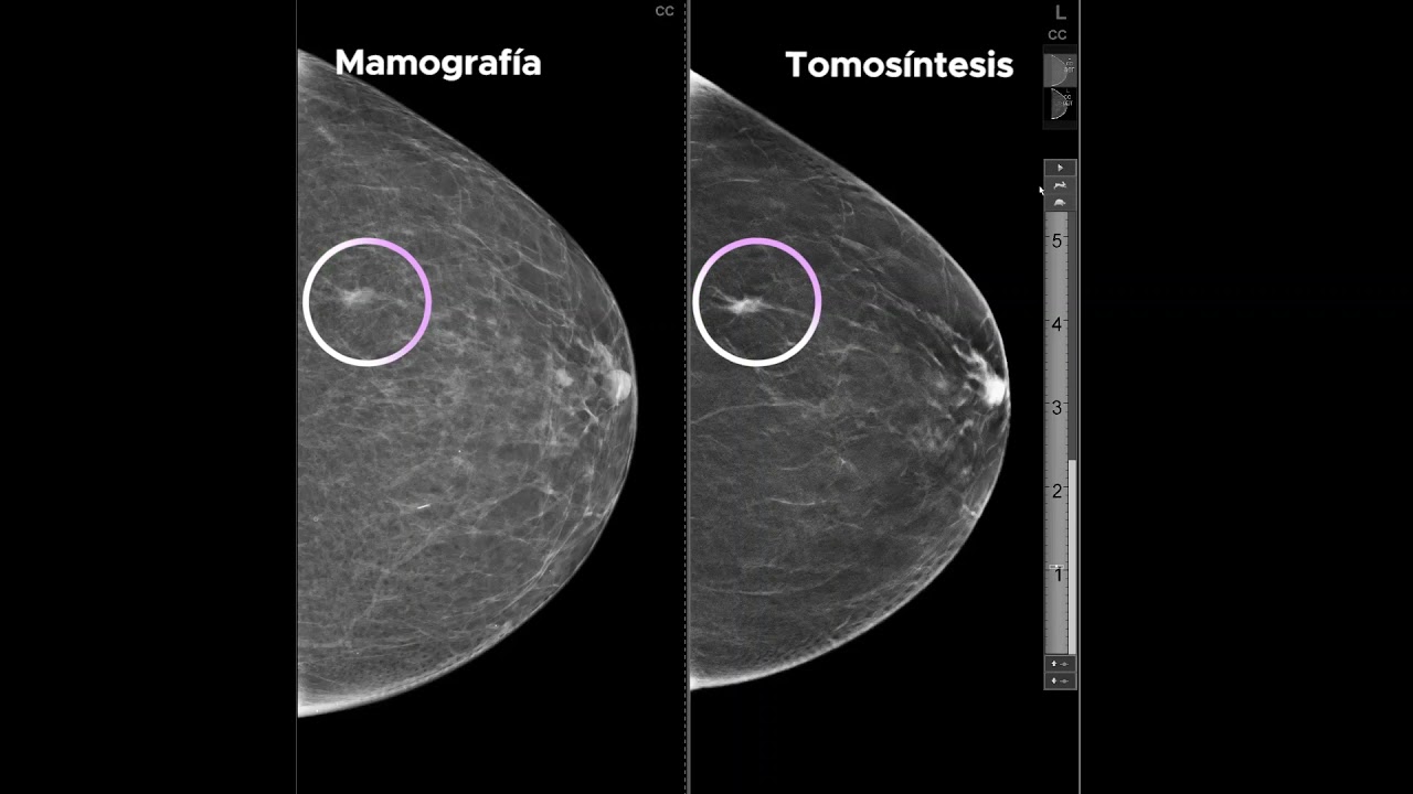 Casos Clínicos - Diagnóstico por Tomosintesis