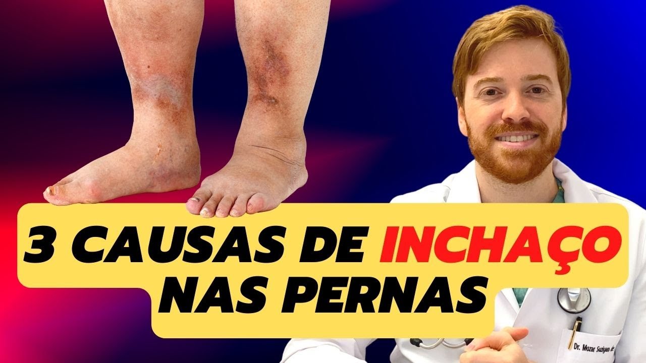 CAUSAS COMUNS DE INCHAÇO NAS PERNAS!