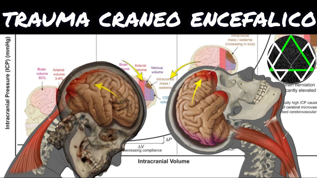 TRAUMATISMO CRANEOENCEFALICO SEVERO, HIPERTENSION INTRACRANEAL, DOCTRINA DE MONROE KELLY