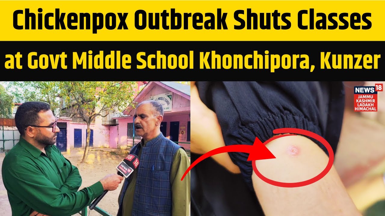 Chickenpox Outbreak Shuts Classes at Govt Middle School Khonchipora, Kunzer | News18 JKLH | N18V