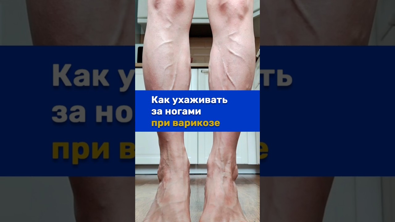 Уход за кожей ног при варикозе
