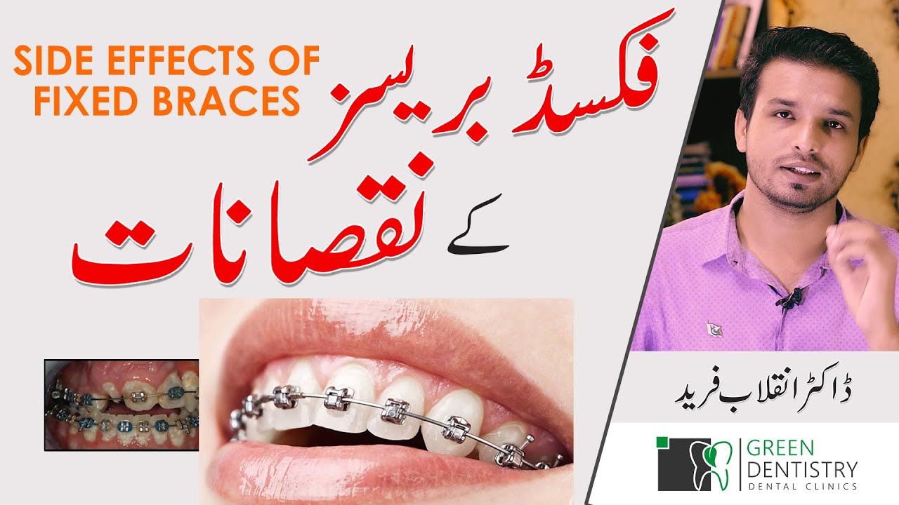 Side Effects of Fixed Braces | How to Deal with Problems with Braces | Dr. Inqalab | Urdu | Hindi