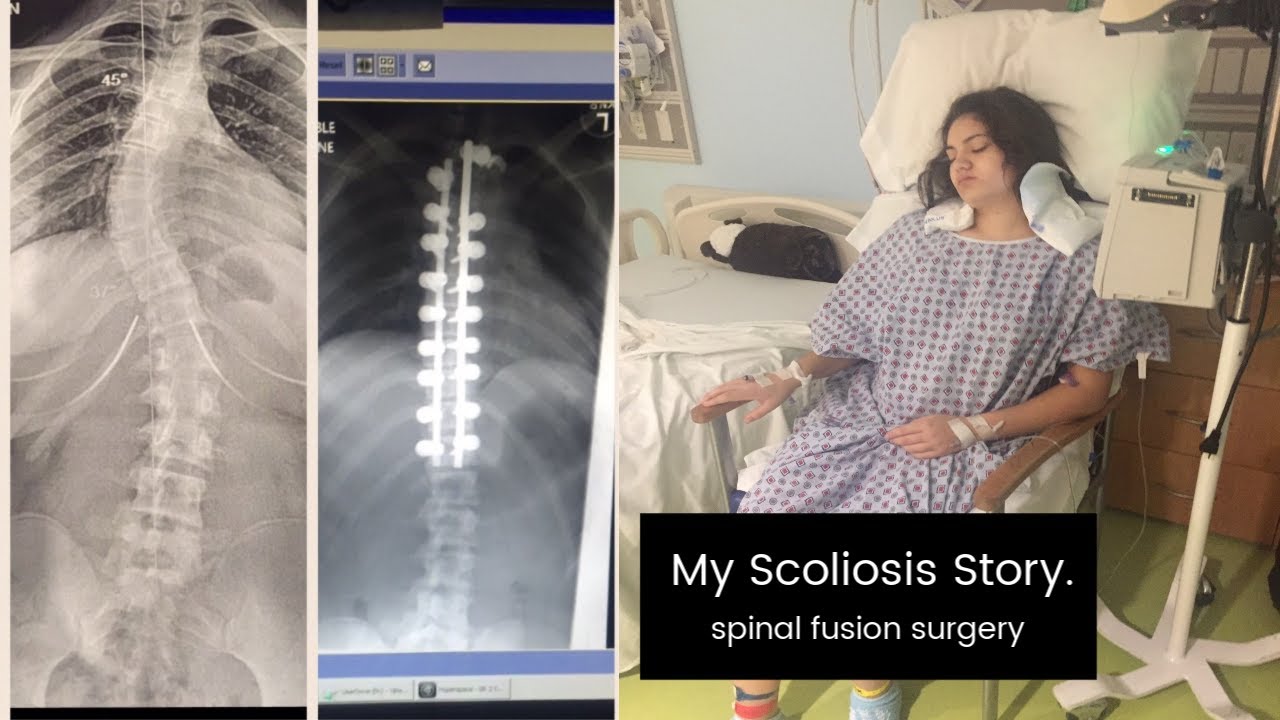 My Scoliosis Surgery Story | spinal fusion surgery & how it affected my life today