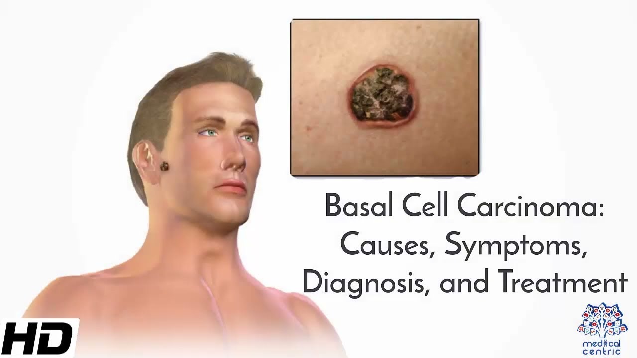 Basal Cell Carcinoma: Causes, Symptoms, Diagnosis and Treatment.