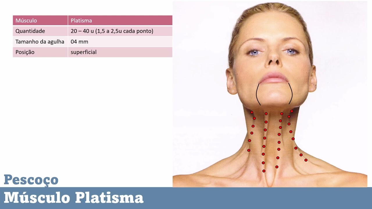 tecnica nefertiti toxina botulinica para pescoco