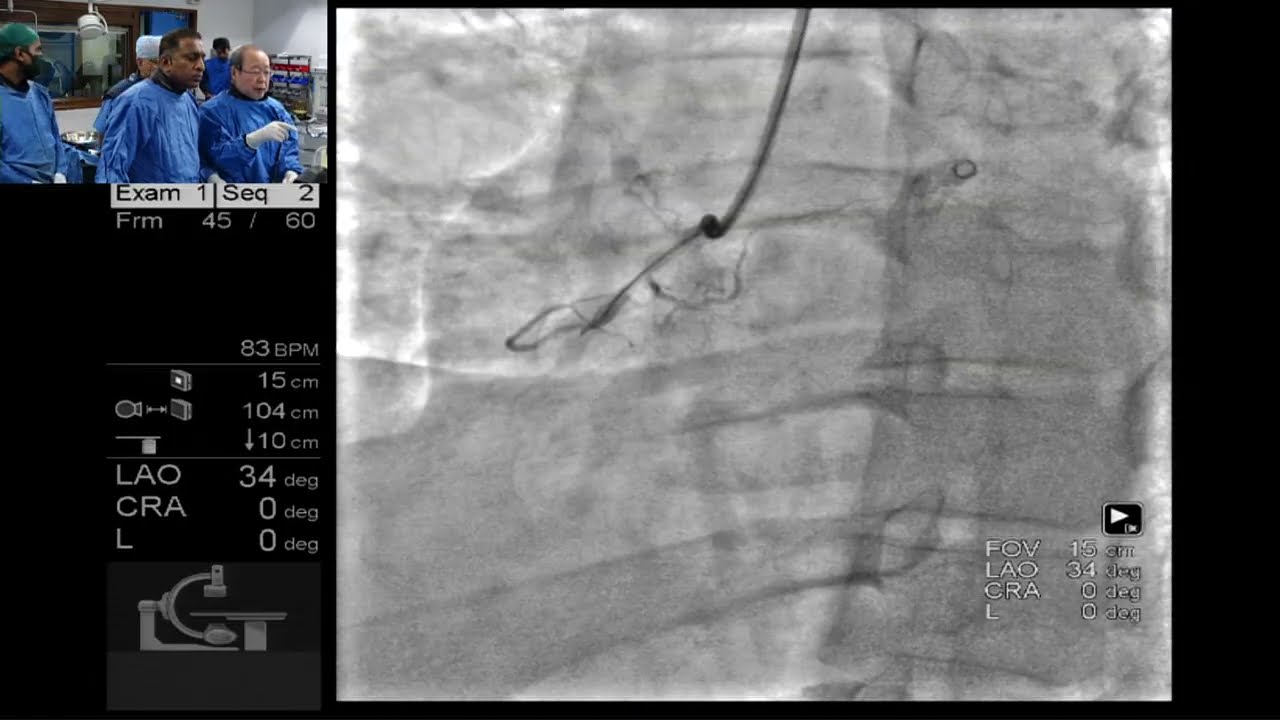 A long-segment CTO of the mid-RCA by Dr. Shigeru Saito