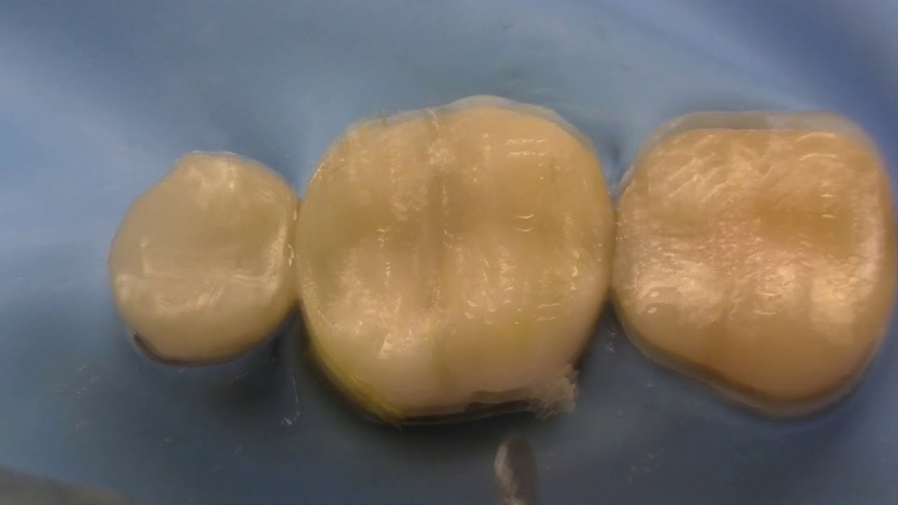 Class II - Bulk Fill