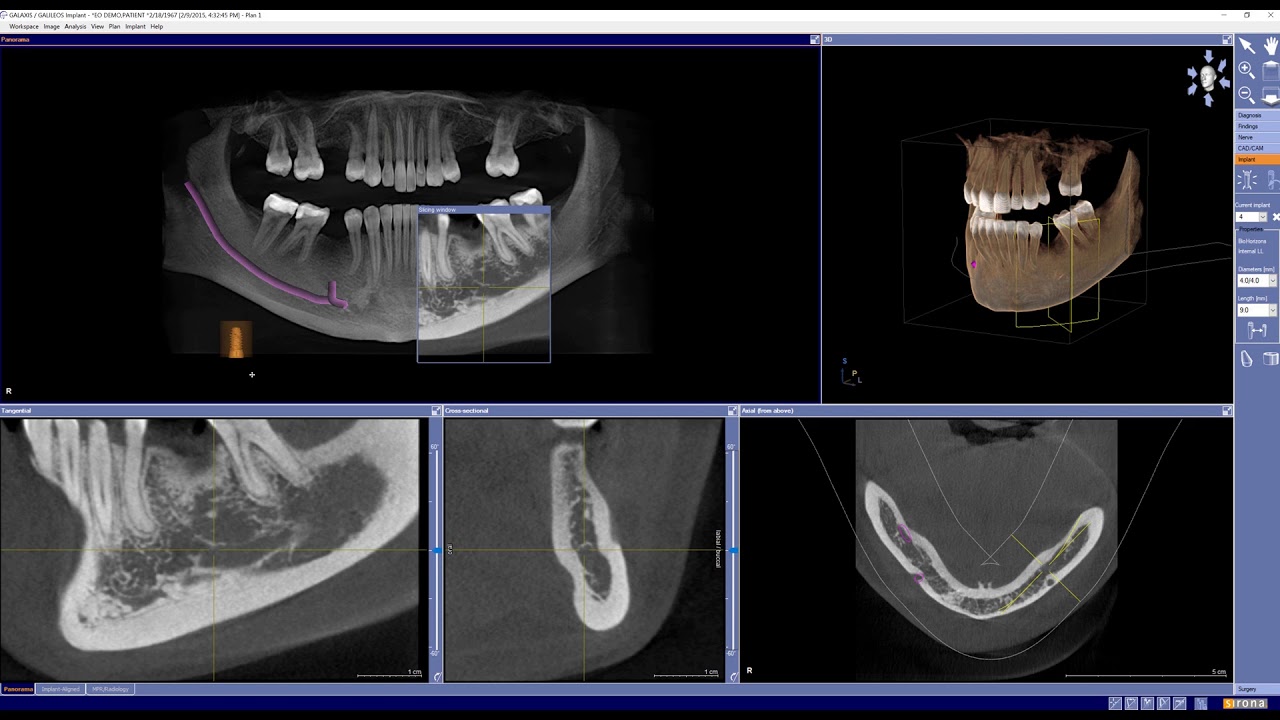 Galaxis Tutorial 5 - Implant Planning